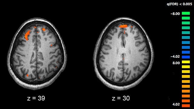 Schizophrenia fMRI brain scans are shown.